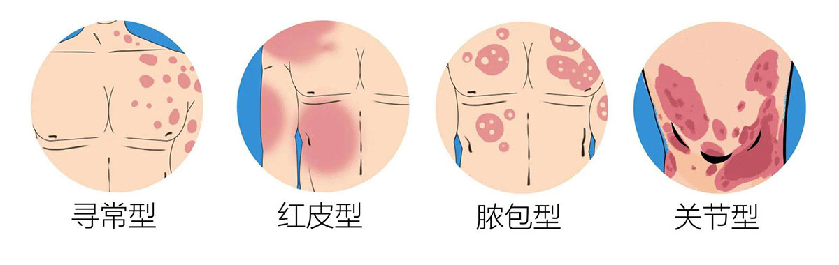 寻常型牛皮癣